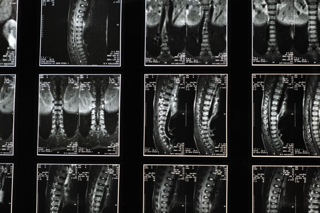Degenerative Disc Disease