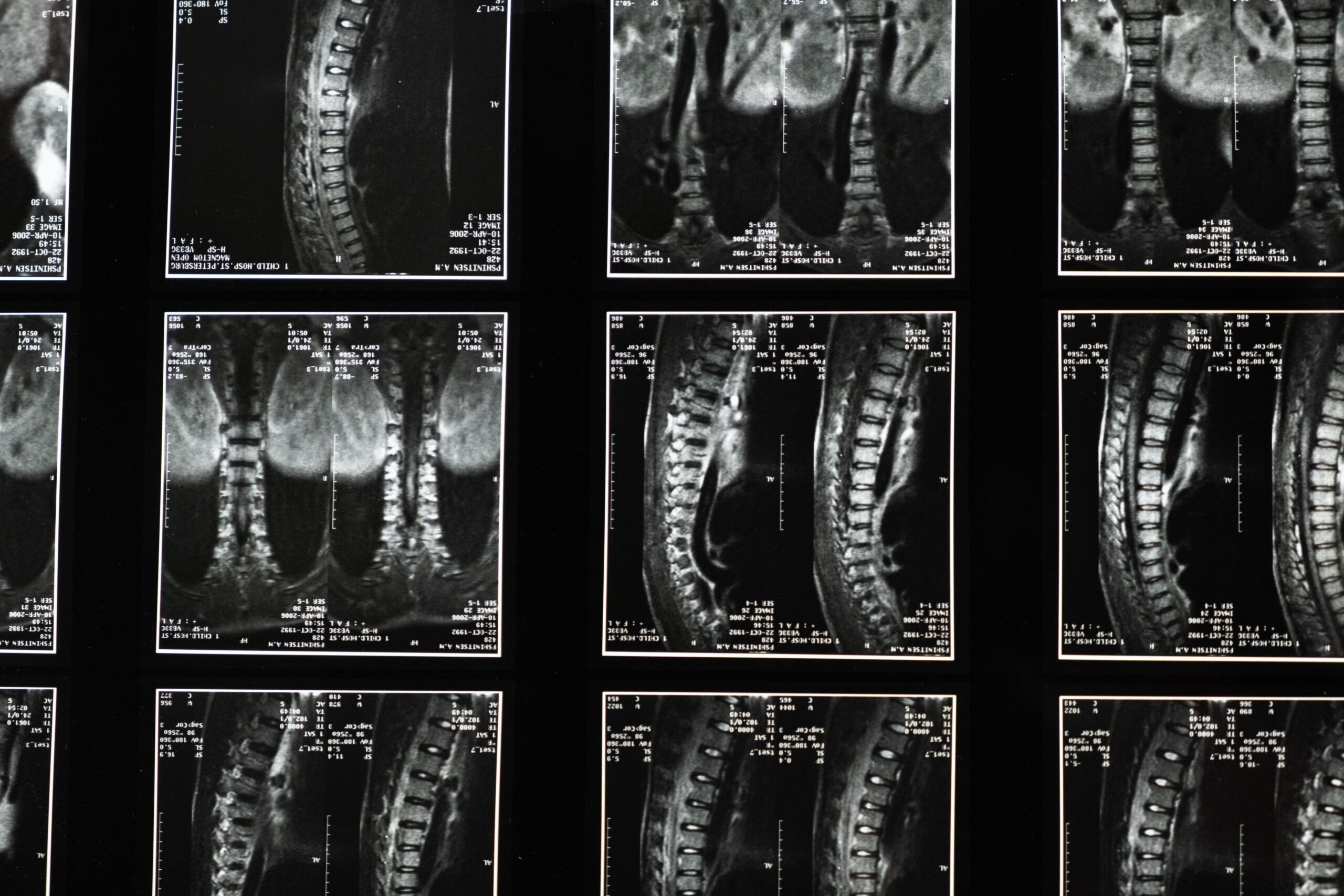 Degenerative Disc Disease
